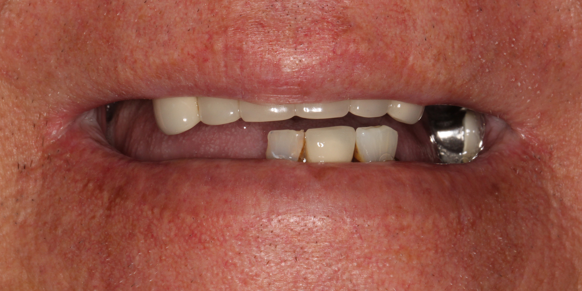 Before-Dentures