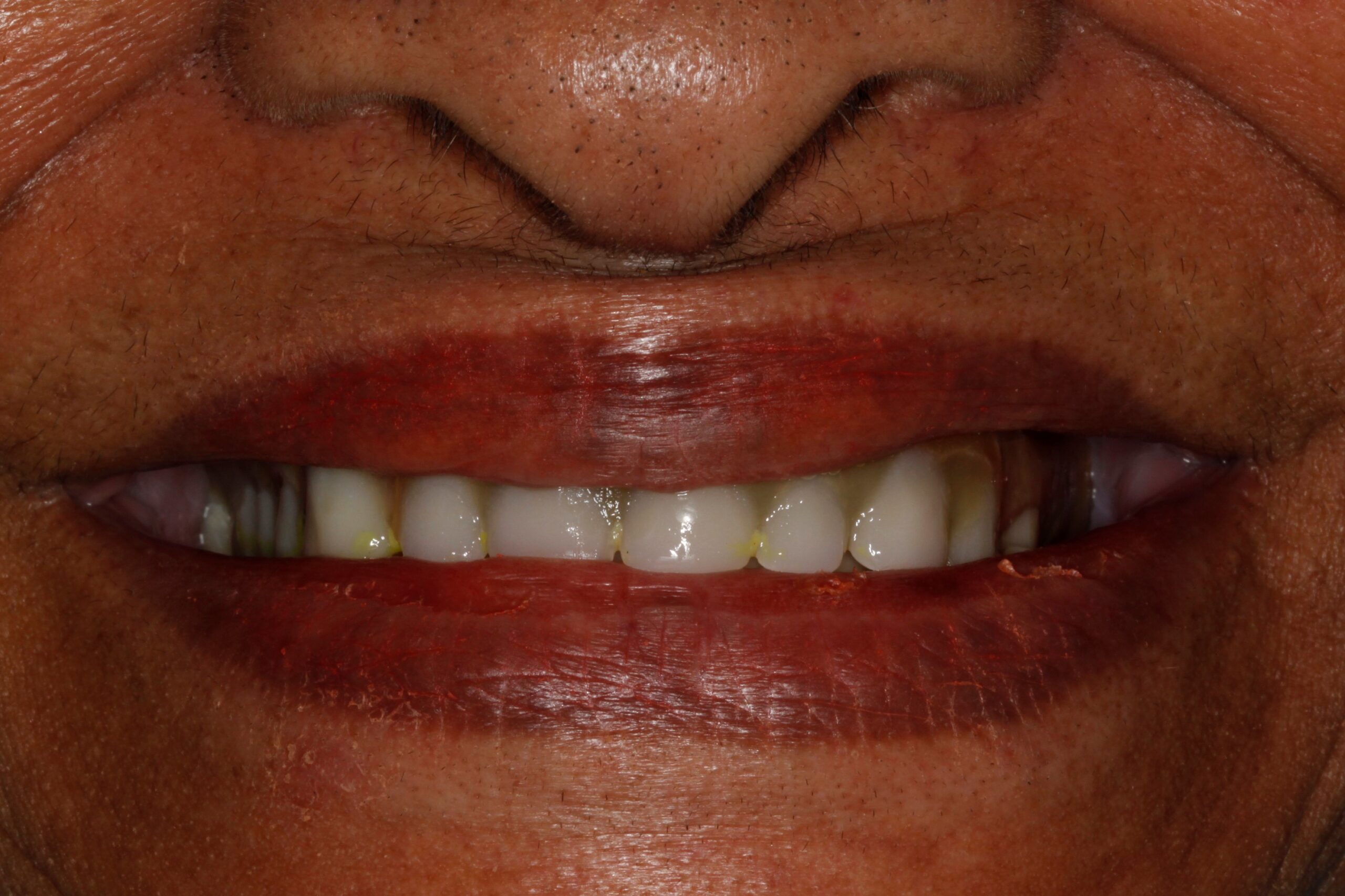 Before-Example of new Dentures